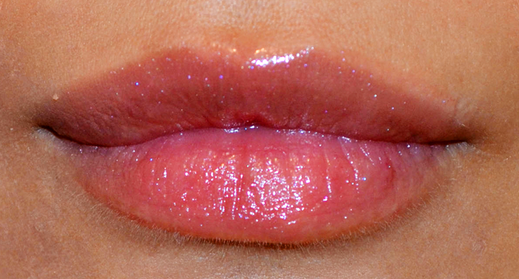 Hyaluronic Acid and Dermal Fillers
