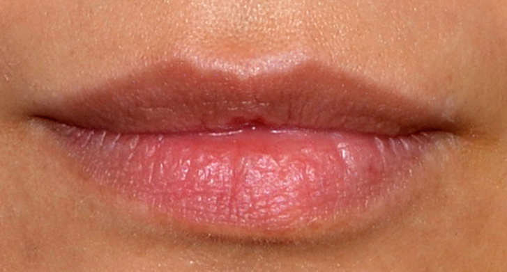 Dermal Fillers: Now using the Belotero® range.